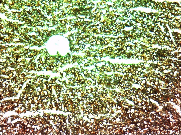 肝淀粉样变1(淀粉染色)10x10