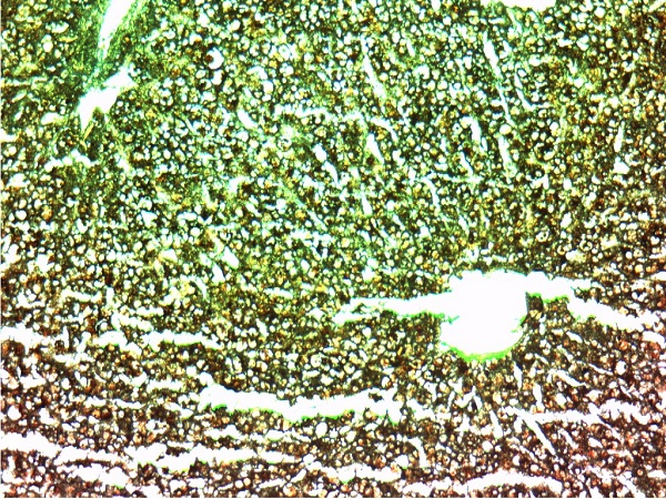 肝淀粉样变2(淀粉染色10x10)
