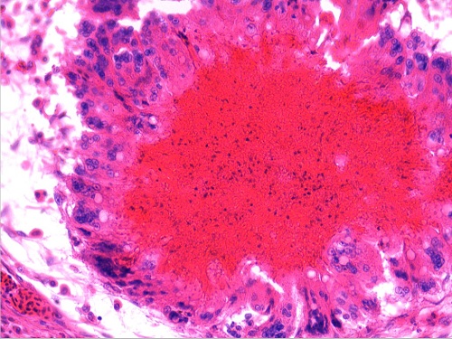 淋巴结大肠杆菌肉芽肿2