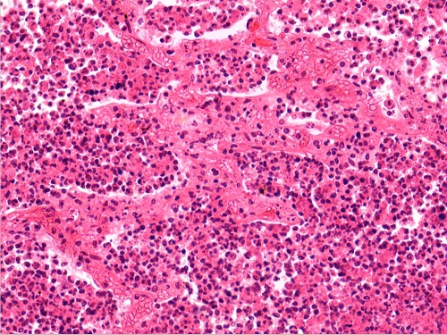 化脓性肺炎3(10x40)